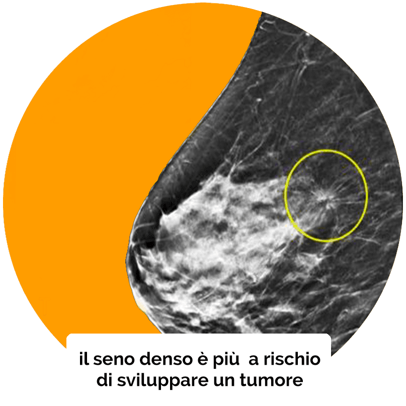 senso denso più a rischio tumore