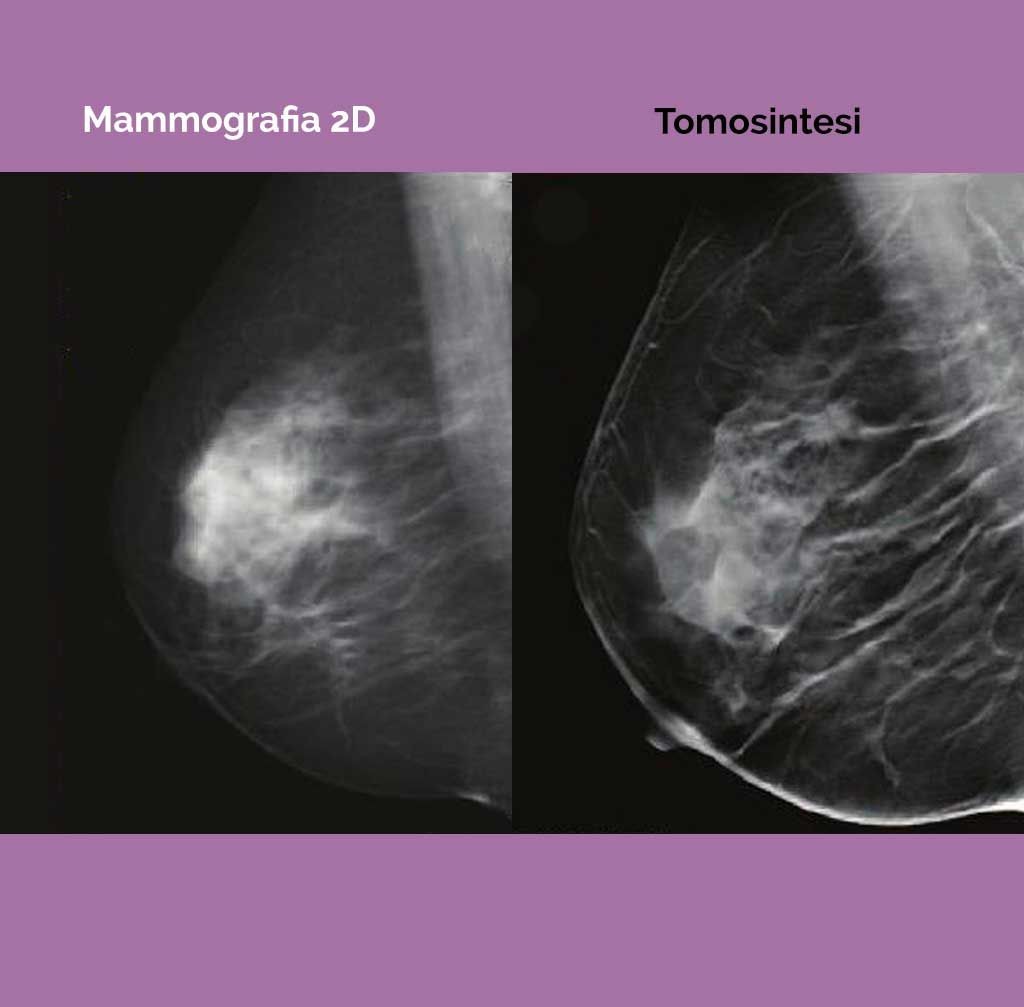 mammografia 2D e tomosintesi a confronto